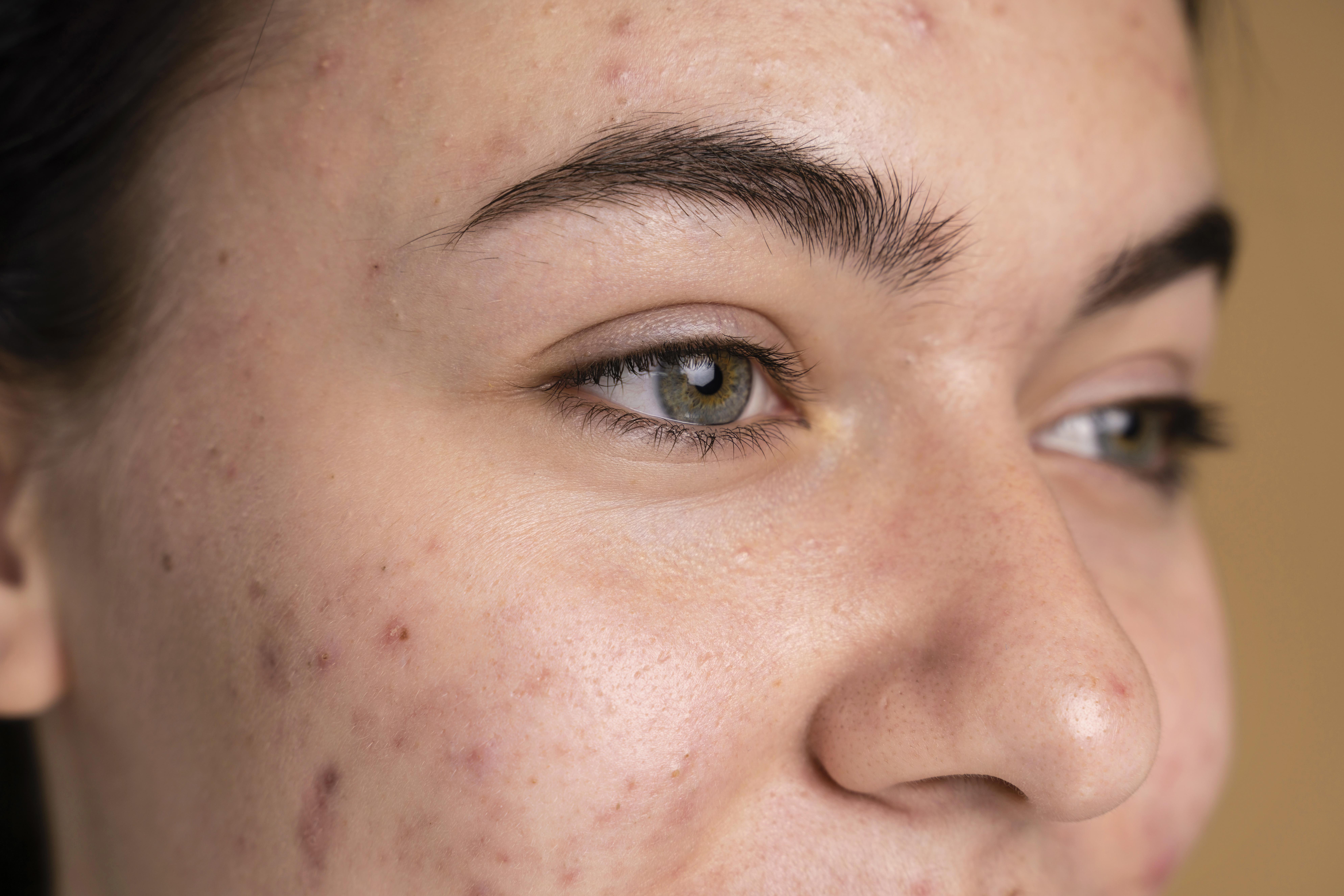 Treat Acne Scars at Home: Best Devices and Technologies for Real Results