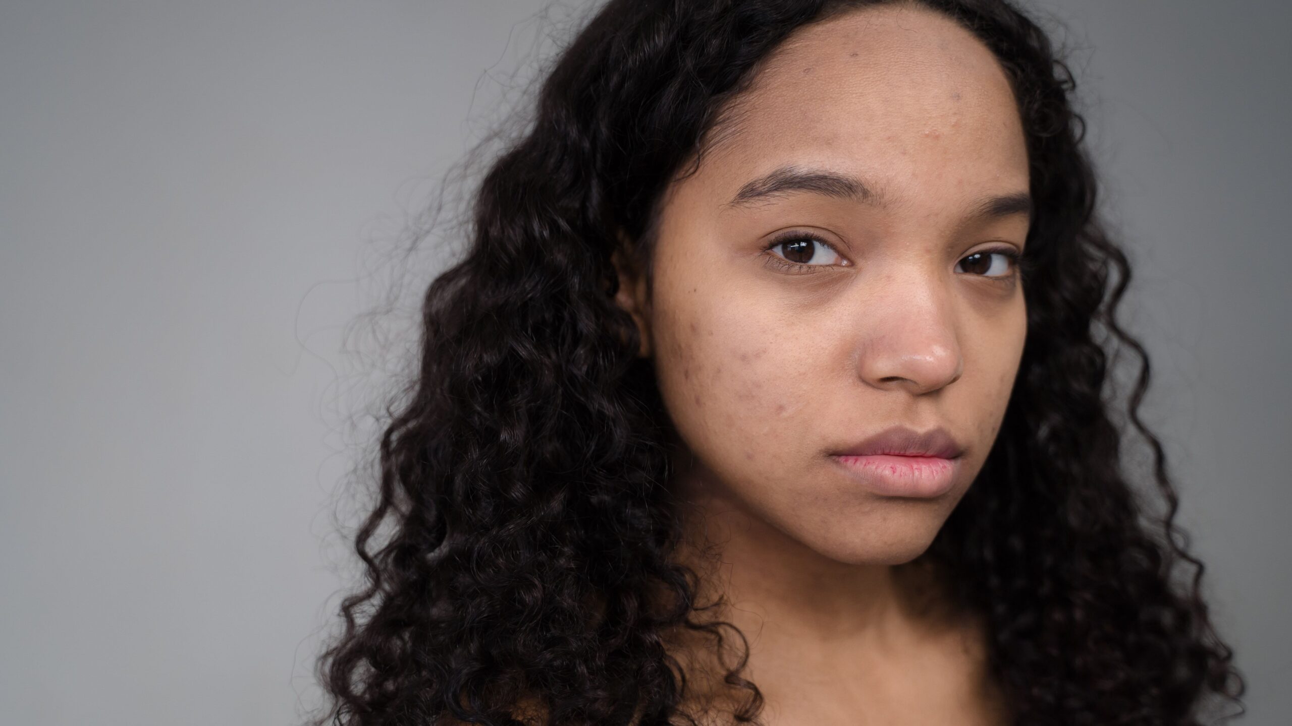 Home Lasers vs Peels: Fade Hyperpigmentation the Right Way