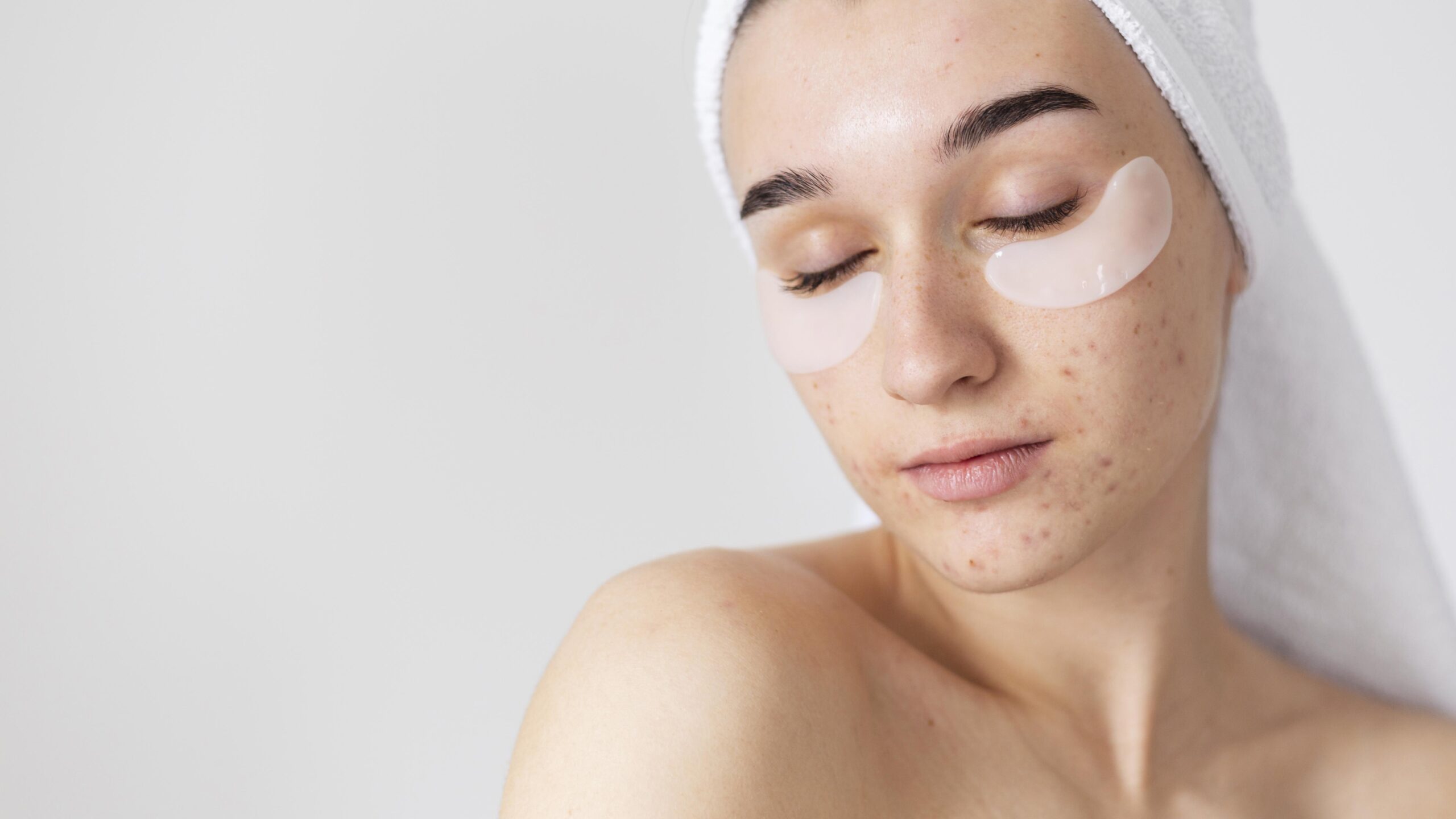 PDRN for Acne Marks: Can Topical Skincare Actually Help?